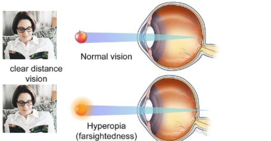 Understanding Hyperopia: Causes, Symptoms, and Treatment Options for Farsightedness