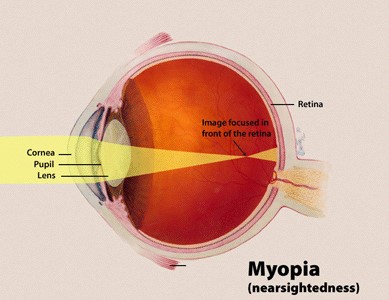 myopia