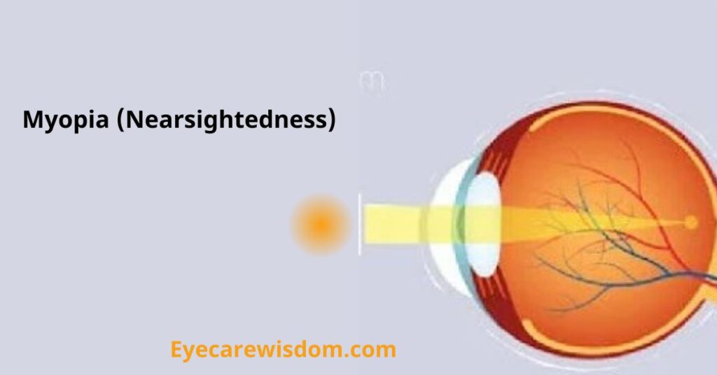 Myopia (Nearsightedness)