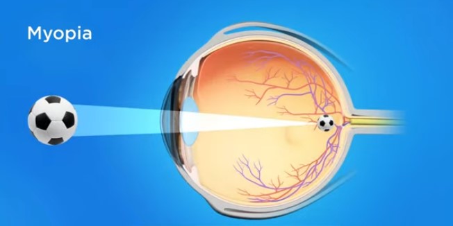 Myopia vs. Hyperopia